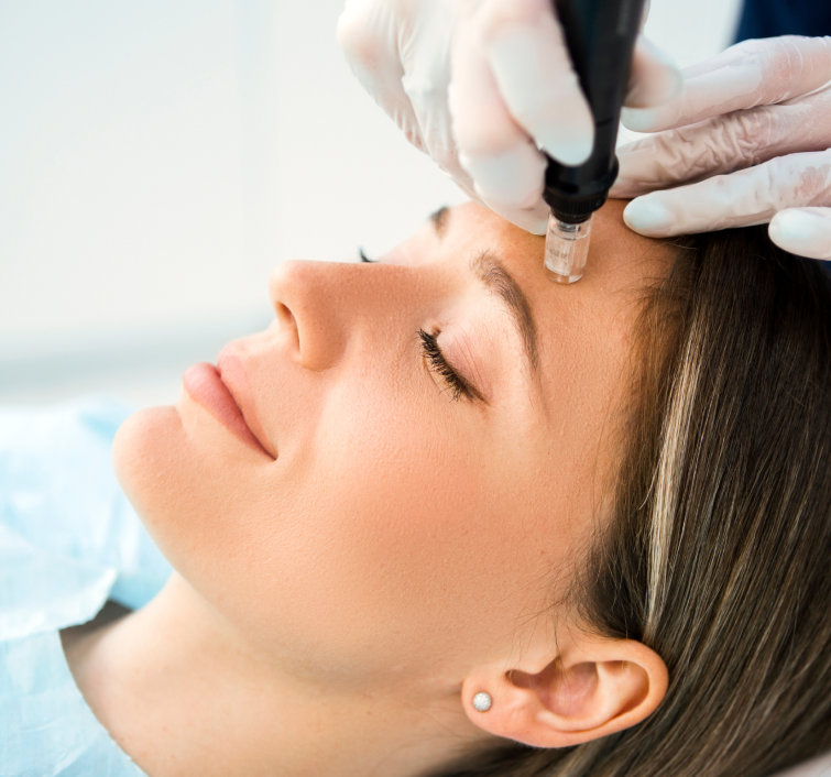 SkinPen Microneedling