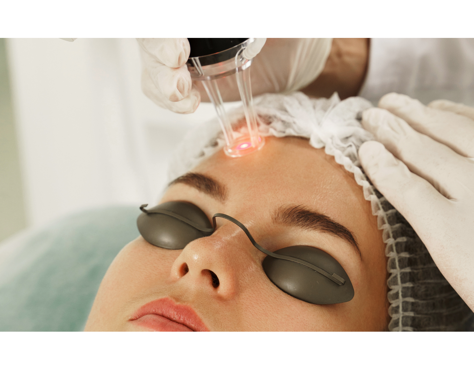 Laser Treatments During Winter: The Perfect Time to Revive Your Skin