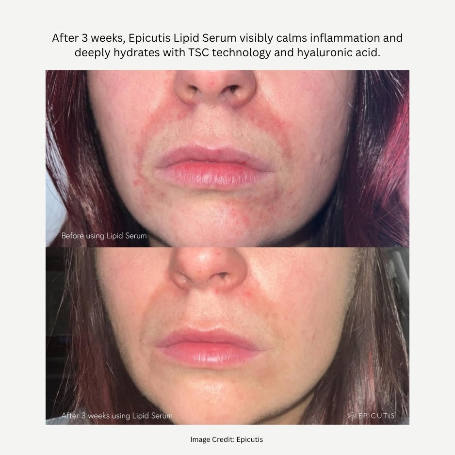 Lipid Serum