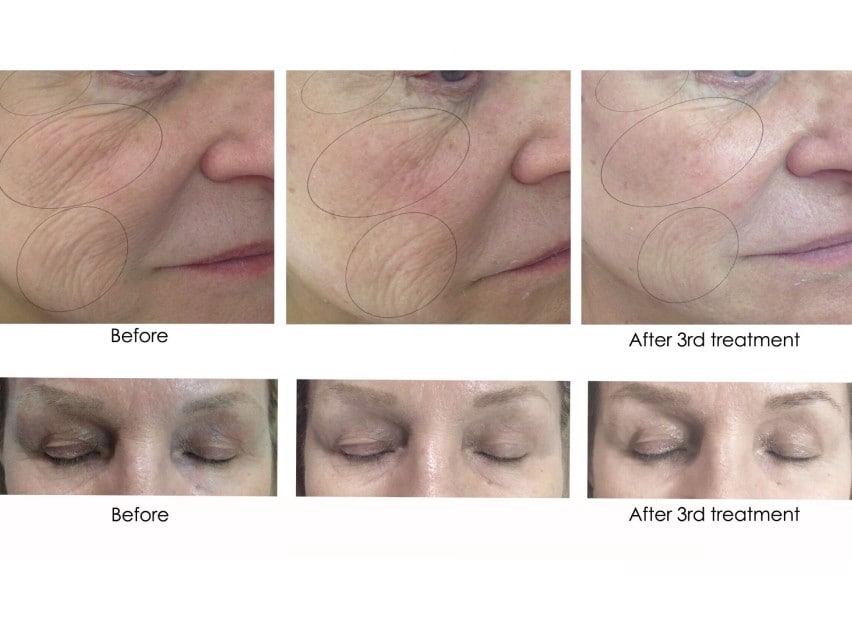 CO2Lift Pro Carboxy Gel Treatment - 3 Treatments