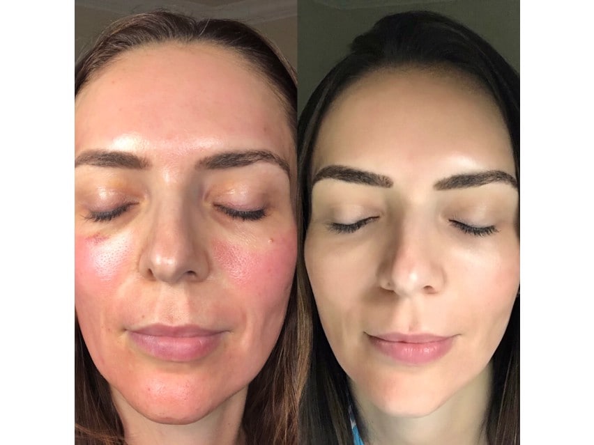 CO2Lift Pro Carboxy Gel Treatment - 3 Treatments